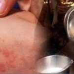 تنتقل عبر لحوم الابقار ومنتجاتها: رصد 8 إصابات بالحمى المالطية في باجة